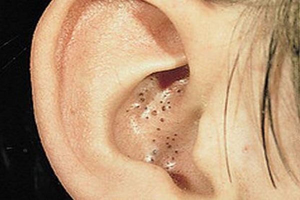 comment enlever les points noirs des oreilles